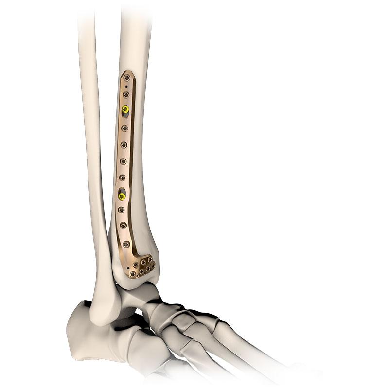 Пластина великогомілкова дистальна латеральна 5,0ChLP